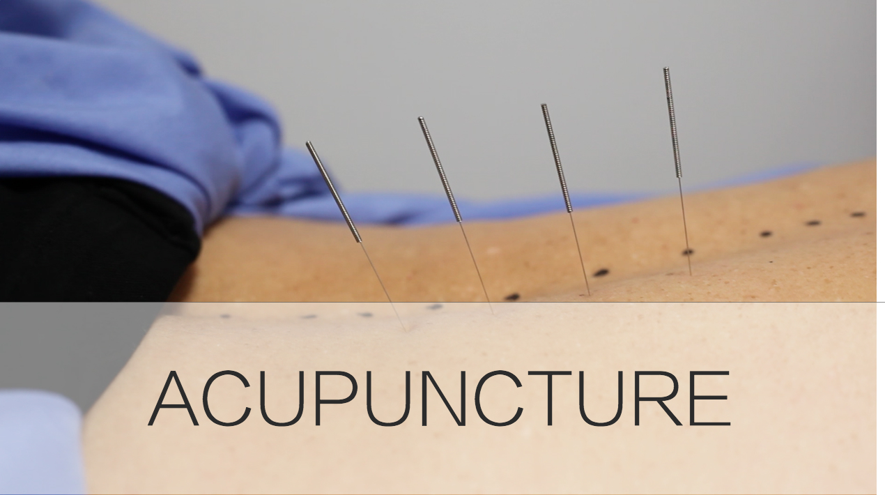 Acupuncture PhysioChiroWellness Vaughan Newmarket