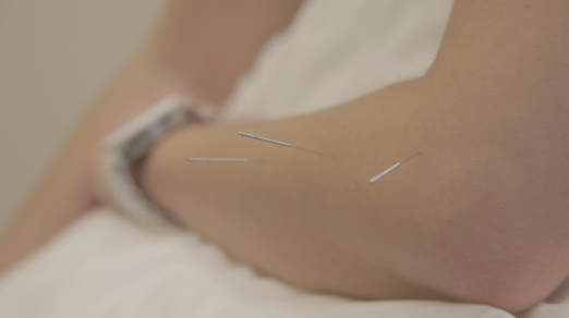 acupuncture treatment for elbow pain newmarket