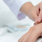 Acupuncture Acupuncturist