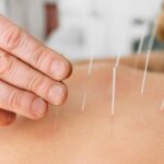 acupuncture-physiochirowellness-ajax-newmarket-vaughan-on