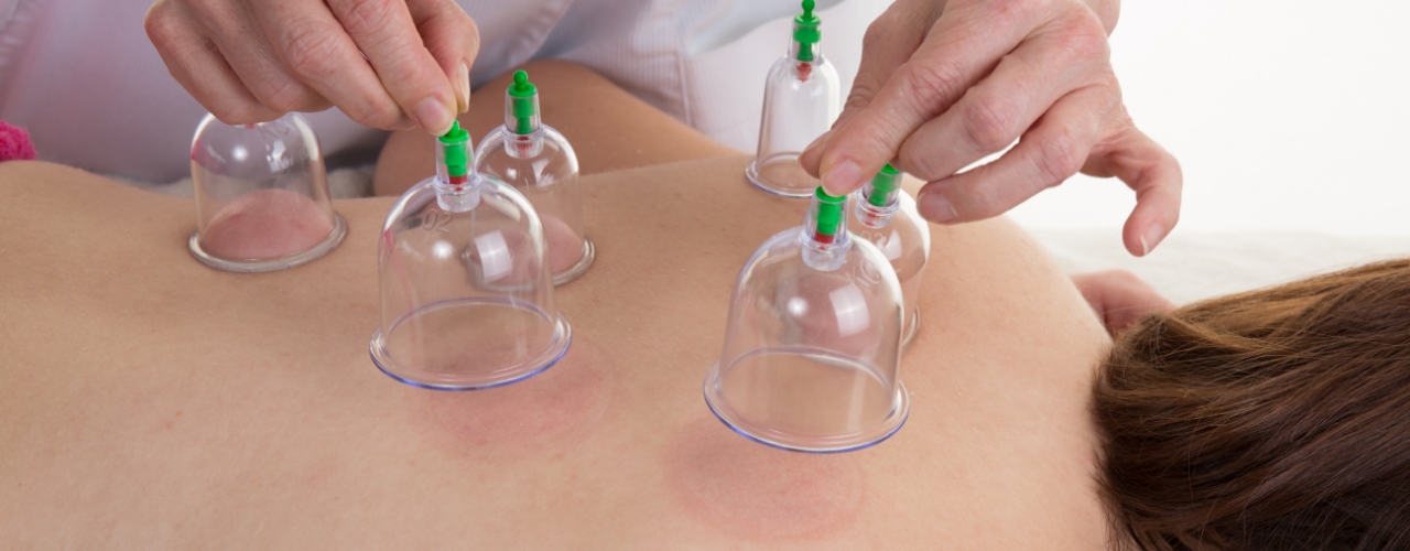 cupping-physiochirowellness-ajax-newmarket-vaughan-on