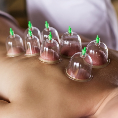 cupping-physiochirowellness-ajax-newmarket-vaughan-on