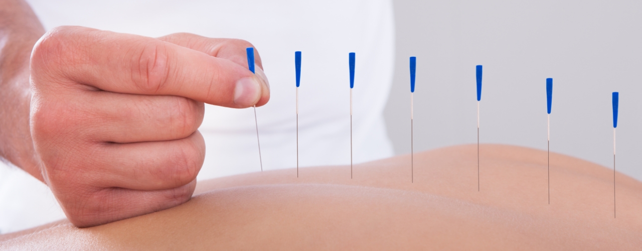 dry-needling-physiochirowellness-ajax-newmarket-vaughan-on