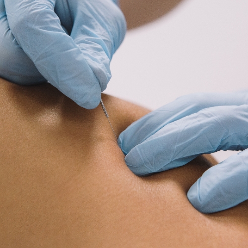 dry-needling-physiochirowellness-ajax-newmarket-vaughan-on