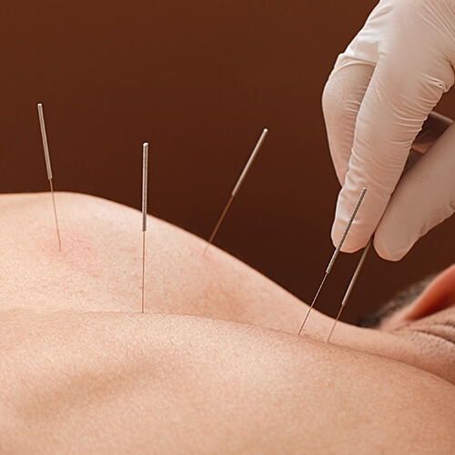 acupunture-physiochirowellness-ajax-newmarket-vaughan-on