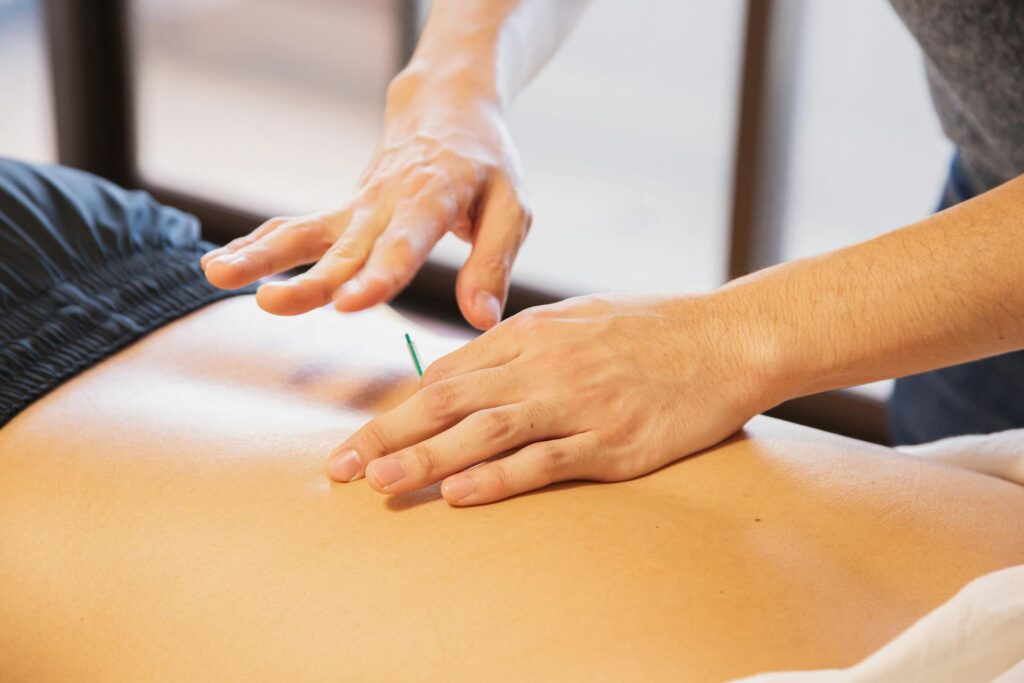 Dry needling Physiotherapy vaughan Newmarket