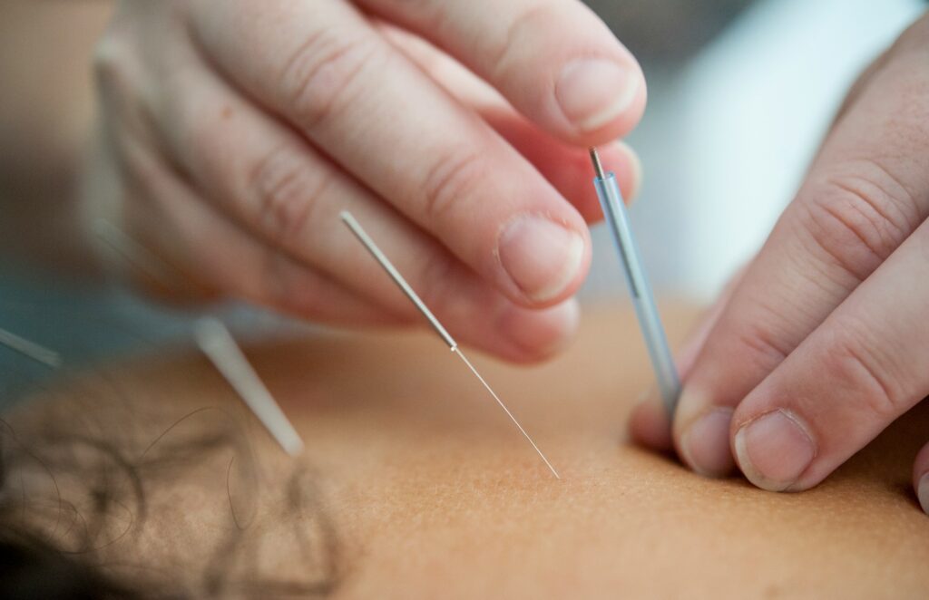 Acupuncture Vaughan Newmarket Stress Relief