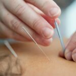 Acupuncture Vaughan Newmarket Stress Relief