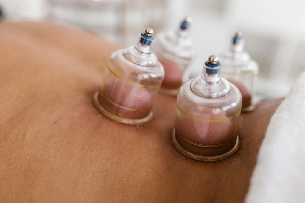 Cupping Therapy Physiotherapy Newmarket Vaughan