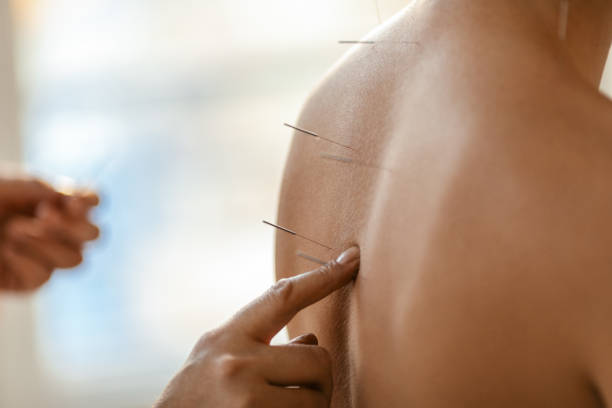 Acupuncture Vaughan Chronic Pain Treatment