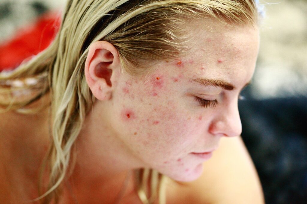 Naturopathy Newmarket Acne Treatment