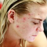 Naturopathy Newmarket Acne Treatment