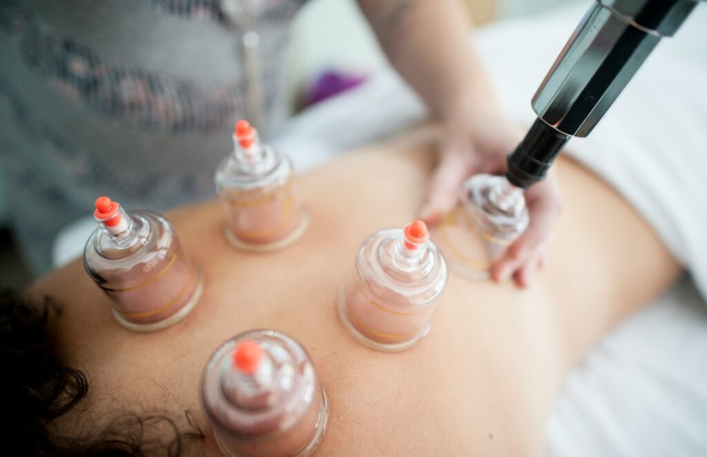 Physiotherapy Vaughan woman having cupping session