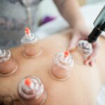 Physiotherapy Vaughan woman having cupping session