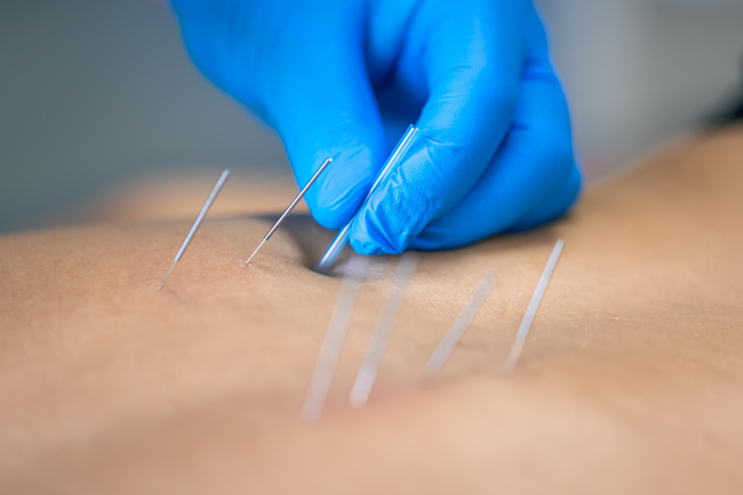 A licensed practitioner performing acupuncture in Newmarket for holistic pain relief