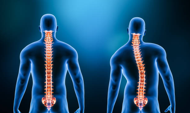 Chiropractor in Vaughan performing specialized scoliosis assessment on patient showing spinal curvature