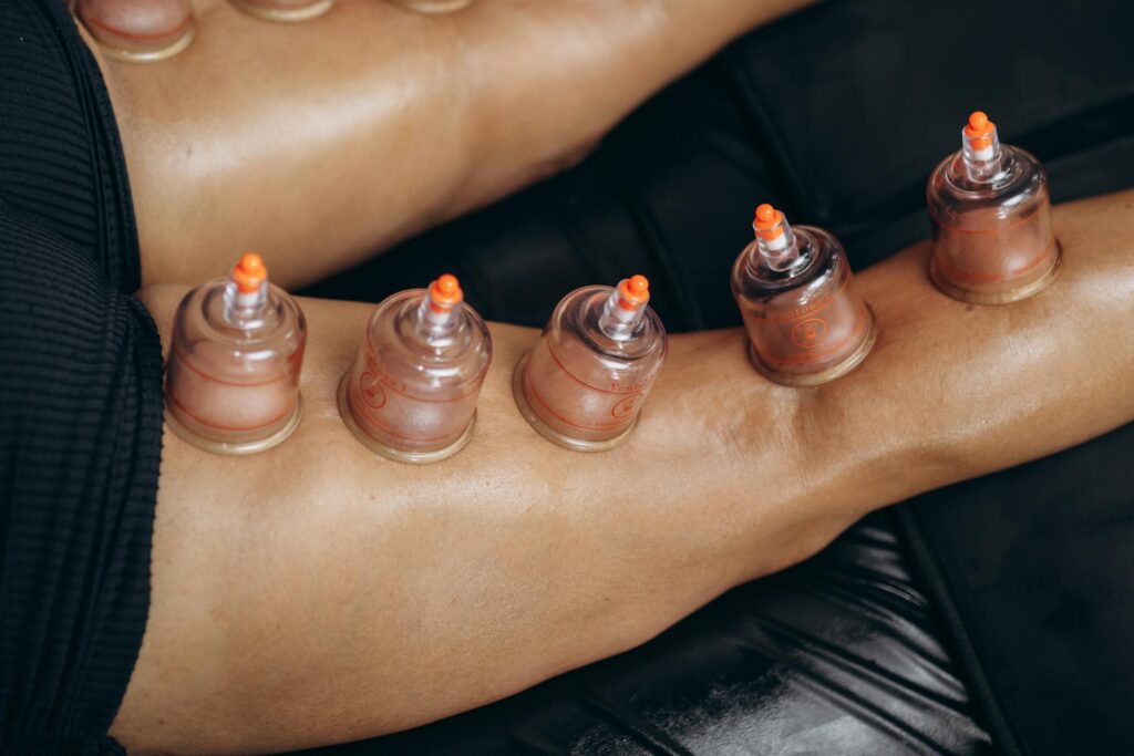 Physiotherapist applying cupping therapy to a patient in Newmarket clinic for muscle tension relief