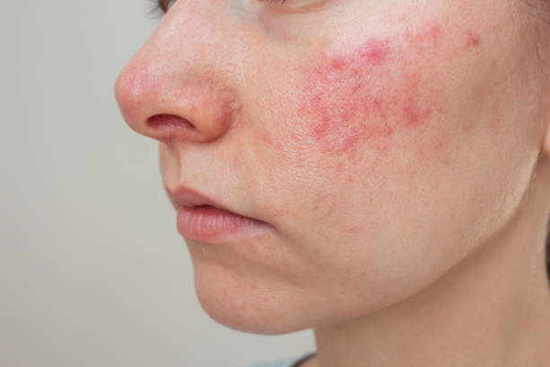 Woman consulting with a naturopathic doctor in Vaughan about natural rosacea treatments