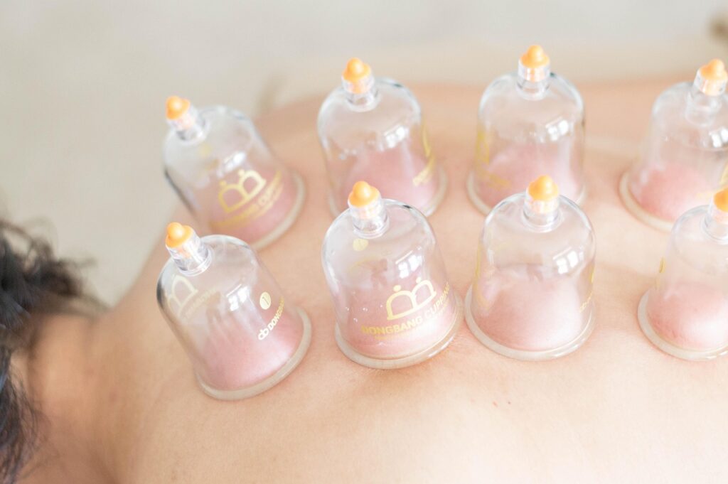 Close-up view of cupping therapy for muscle pain relief